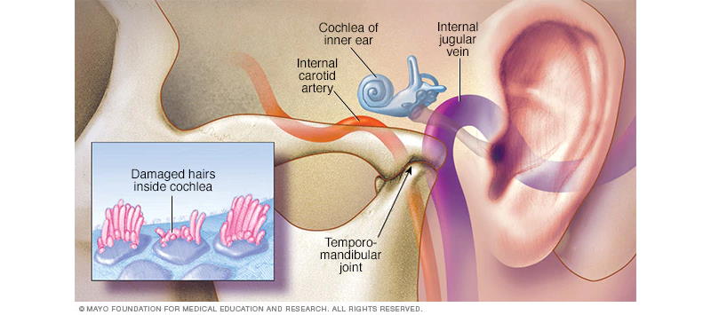Acúfenos o Tinitus - Clínica Mayo